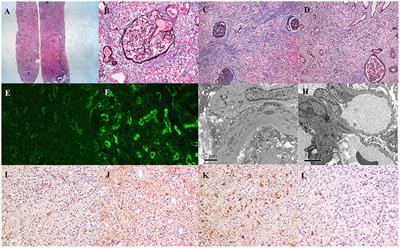 Case Report: Predominant Tubulointerstitial Lupus Nephritis or the Combination With IgG4-Related Disease?